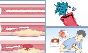  密码保护：动脉硬化症状和功效营养