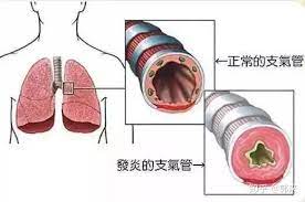  密码保护：肺炎支气管炎症状和功效营养干预